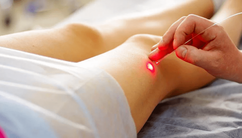 Laserkoagulation von Krampfadern