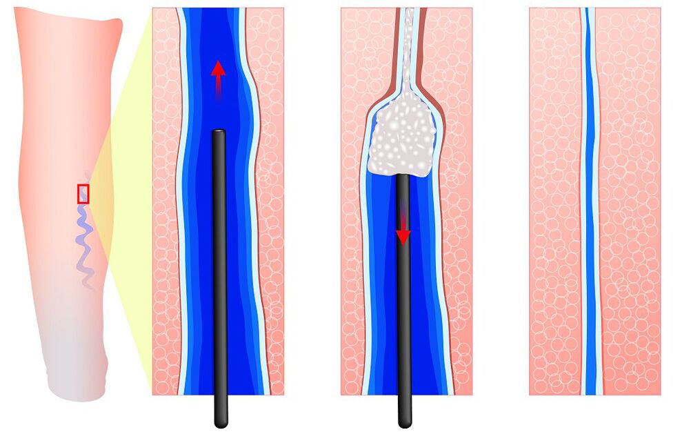 Mechanismus der Sklerotherapie